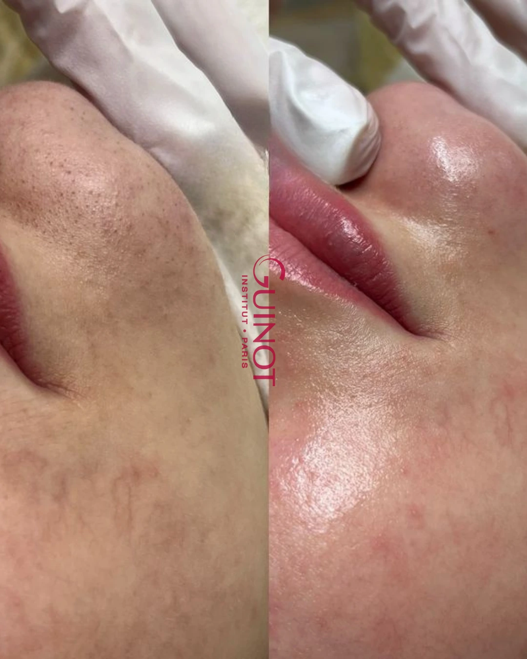 Vorher-Nachher Ergebnis Hautbild Guinot Berlin