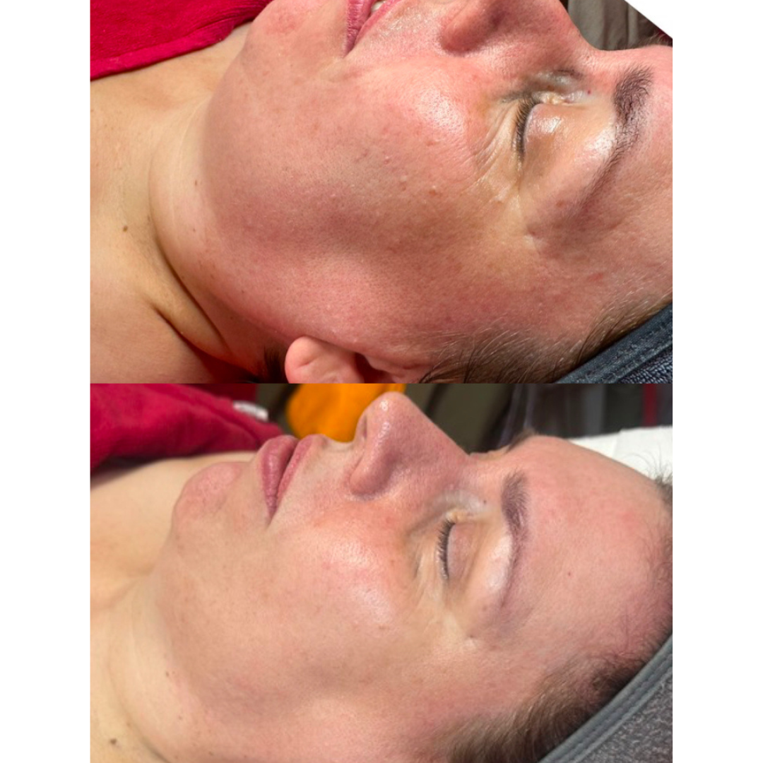 Photofacial Lichttherapie Behandlung im GUINOT Institut Berlin