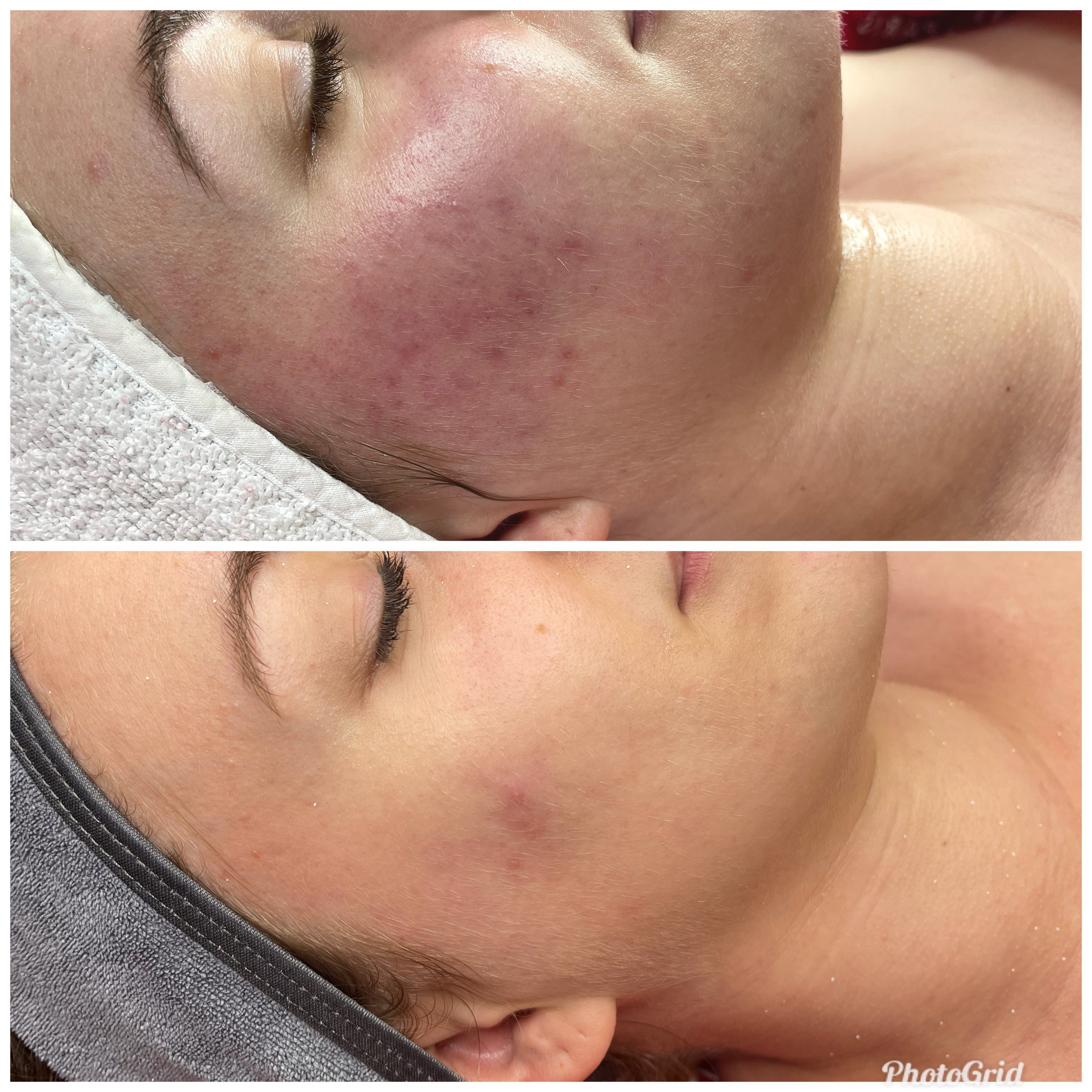 Microneedling Behandlung Berlin - Hautverbesserung
